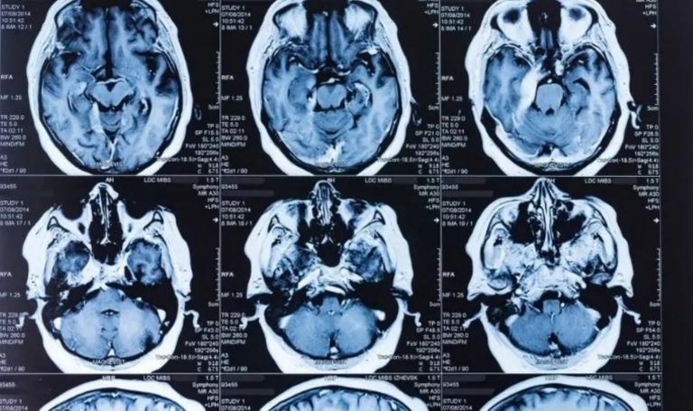 Bu yöntemle yaşlanma önleniyor: Beyin sağlığını korumanın yeni yolu – Son Dakika Hayat Haberleri