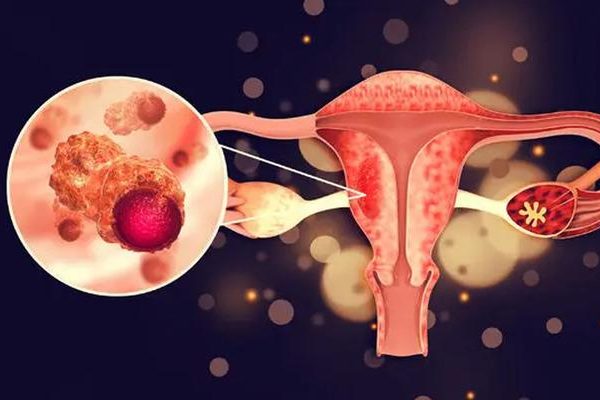 Yumurtalık kanserinde bu semptomlara dikkat edin! Kadınlarda en yaygın kanser türü …