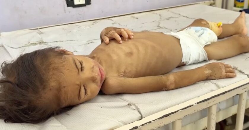 DSÖ: Gazze Şeridi’nde yetersiz beslenmeye bağlı 400 ölüm doğrulandı